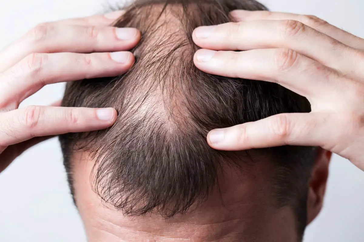 Early Signs Of Balding Causes Next Steps Bald Beards