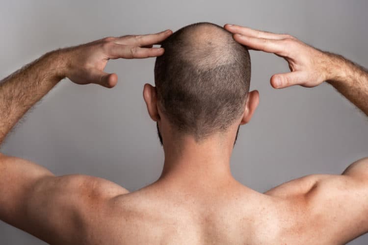 Man showing a developing Bald Spot on the back of his head