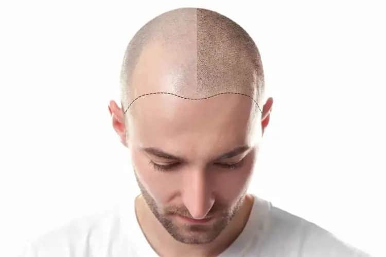 SMP hairline restoration visualization