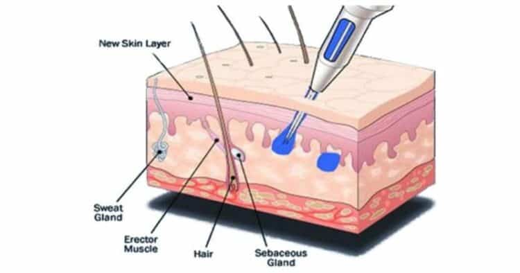 The microneedles used in Scalp Micropigmentation deposit pigment