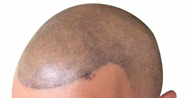 bad SMP pattern placement with a misshapen hairline