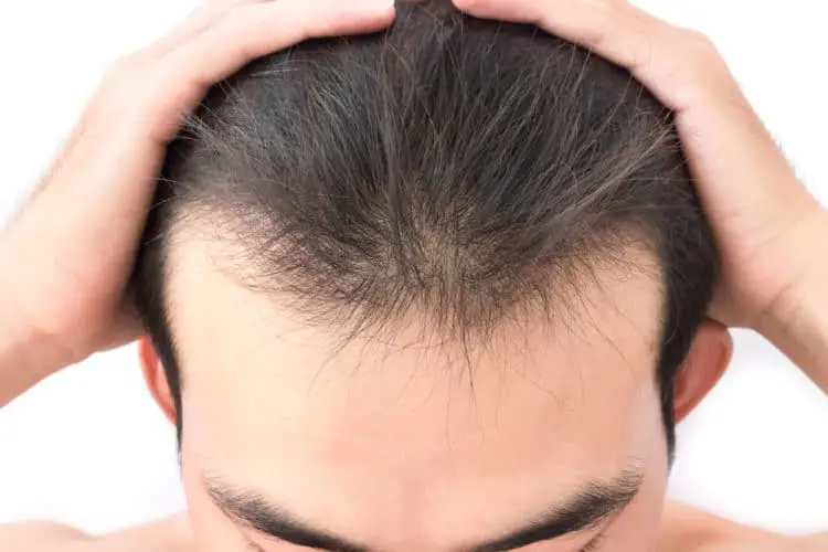 7-ways-to-fix-a-bad-hairline-must-see-bald-beards