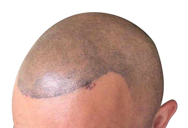 Scalp micropigmentation regrets can come from bad scalp micropigmentation pattern placement.