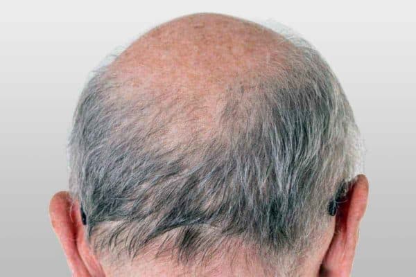 Bald head dandruf