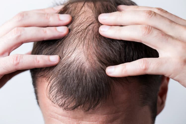 Your hair falling out is a clear sign of balding