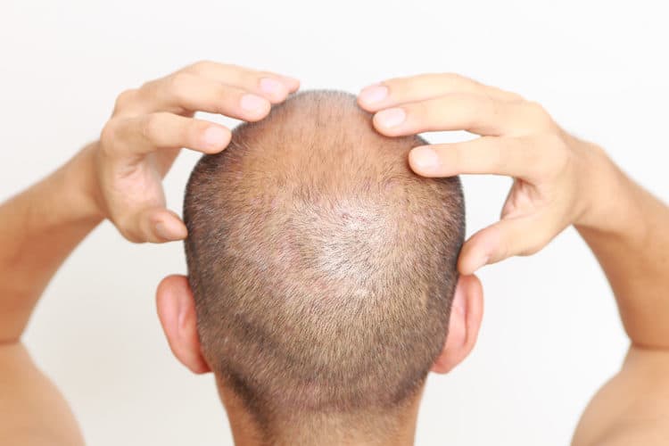 Apply a bald head moisturizer to help fight dandruff.