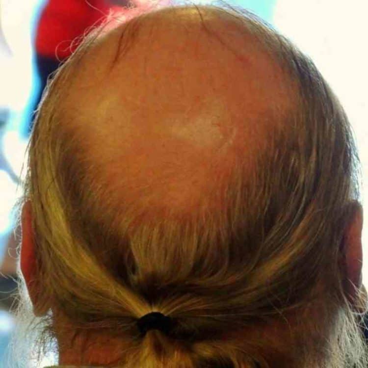 Bald Ponytail Fail