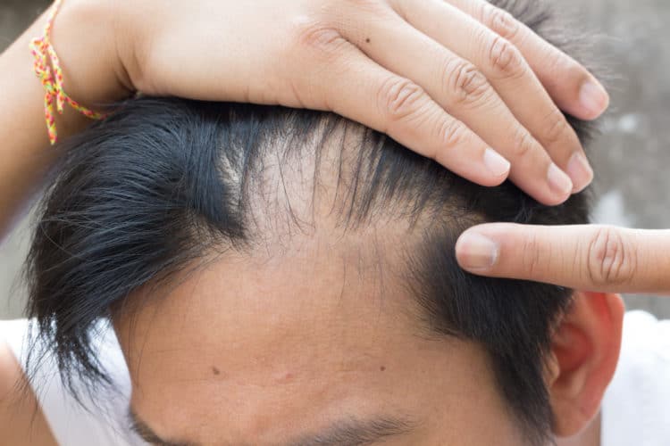 Hair Loss Genetics may be the reason your hair is thinning.