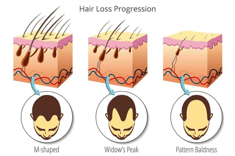 Hair Loss Progression Diagram and Genetics role in balding and hair growth