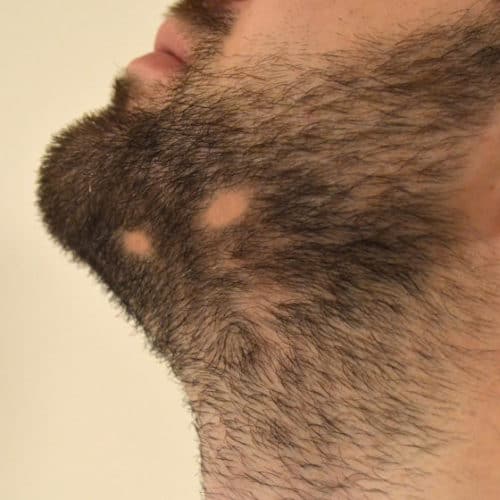 alopecia barbae beard