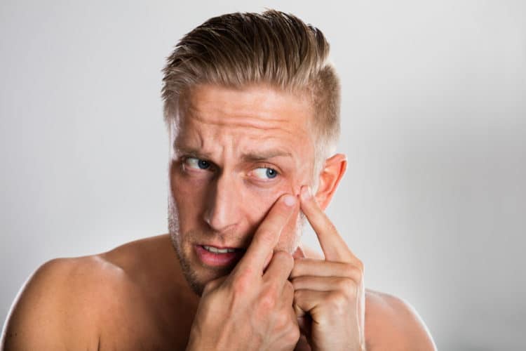 Get Rid of Beard Pimples