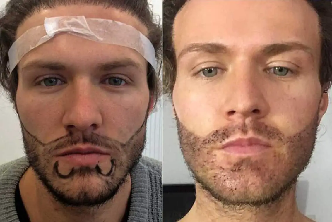 Before and After Beard Transplant Consultation