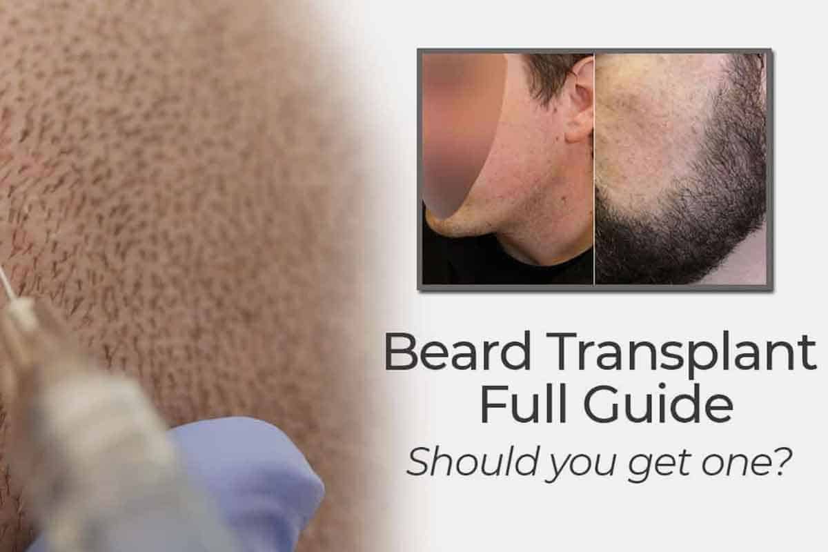 Beard Transplant Guide