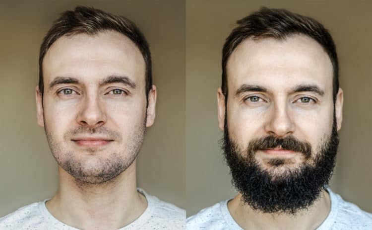 Slow beard growth may be helped with specific growth treatments.