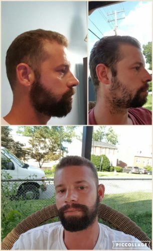 beard growth oil before after
