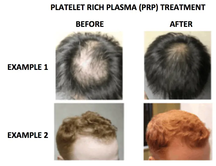 PRP for hair loss - before and after photo