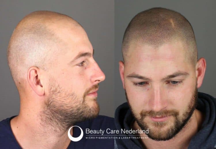 scalp micropigmentation is permanent where tricopigmentation is temporary