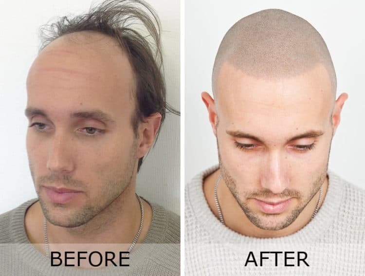 Before and after scalp micropigmentation (SMP)