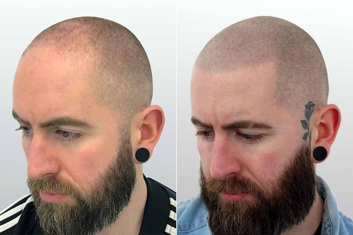 scalp micropigmentation before after
