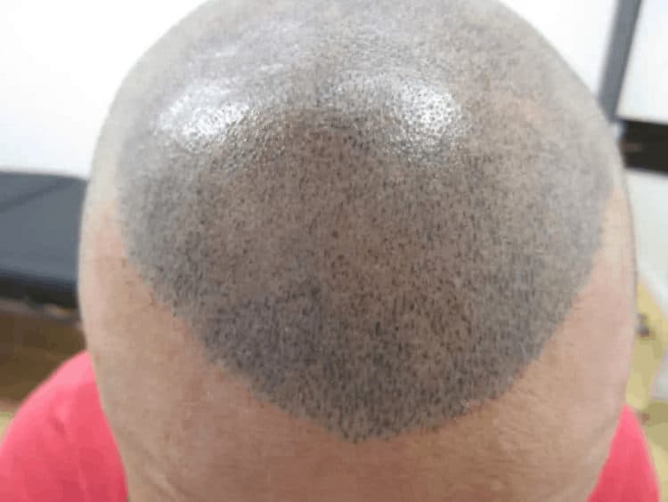 Blue scalp micropigmentation is from inferior ink products.