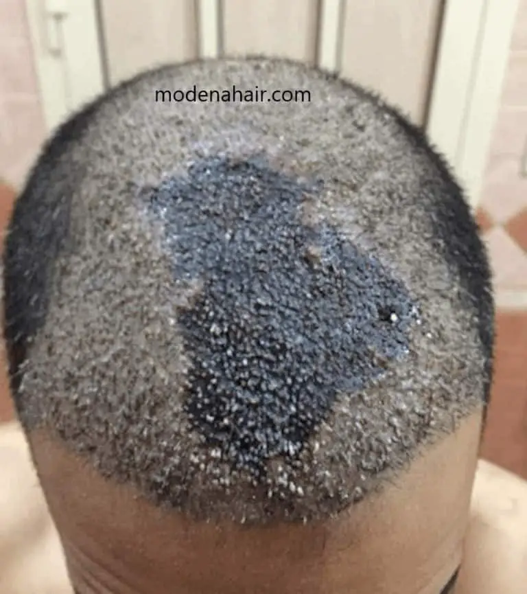 5 Scalp Micropigmentation Regrets + Botched SMP - Bald & Beards