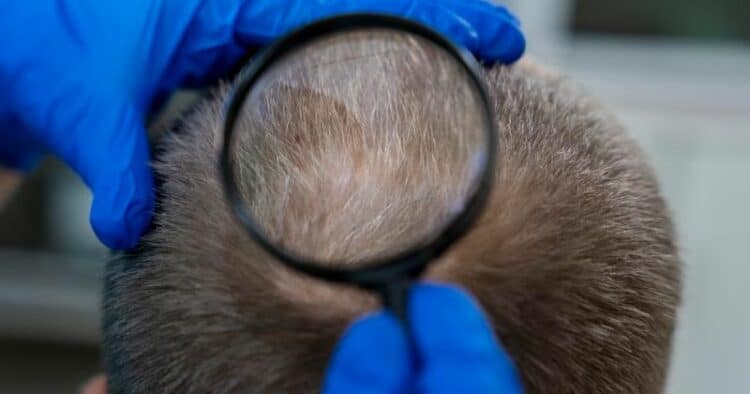 consider scalp micropigmentation even with grey hair