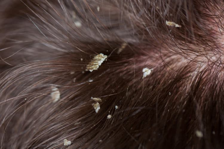 Dandruff vs Dry Scalp