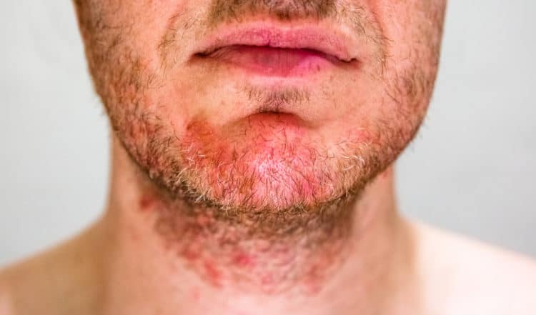 dermatitis beard