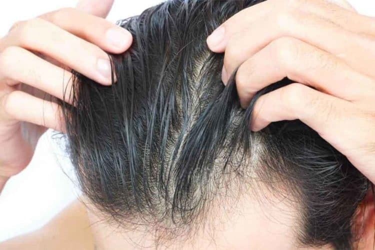 A sign of early balding is seeing your more of your scalp
