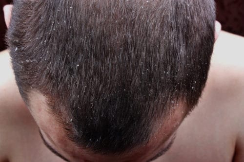 What Causes Dry Scalp: Factors, Symptoms, and Treatments - Bald & Beards