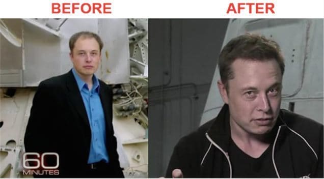 Before and After Elon Musk Hair Transplant