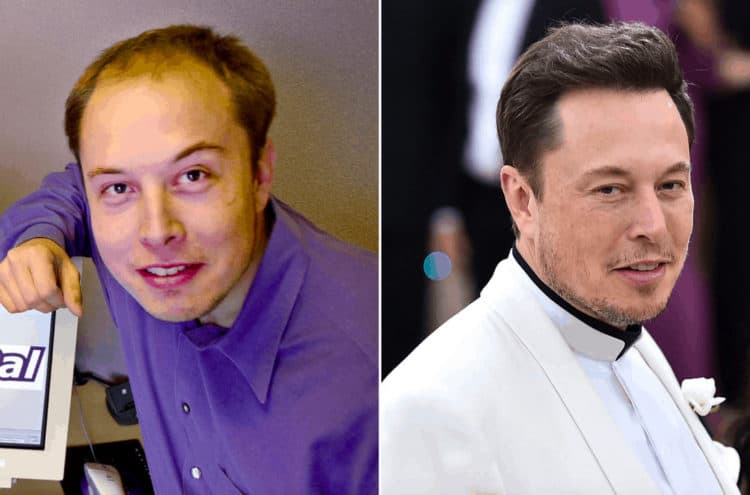 Elon Musk celebrity hair transplant (before and after).