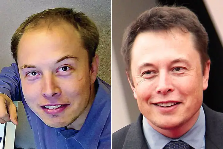 Elon Musk before and after receding hairline.