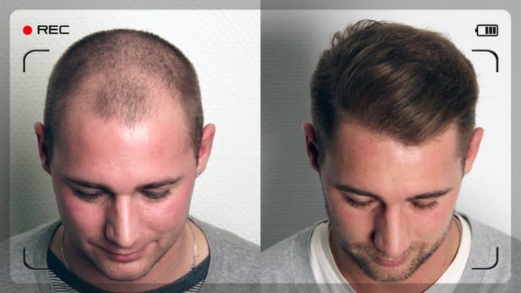 Before After FUE Transplant