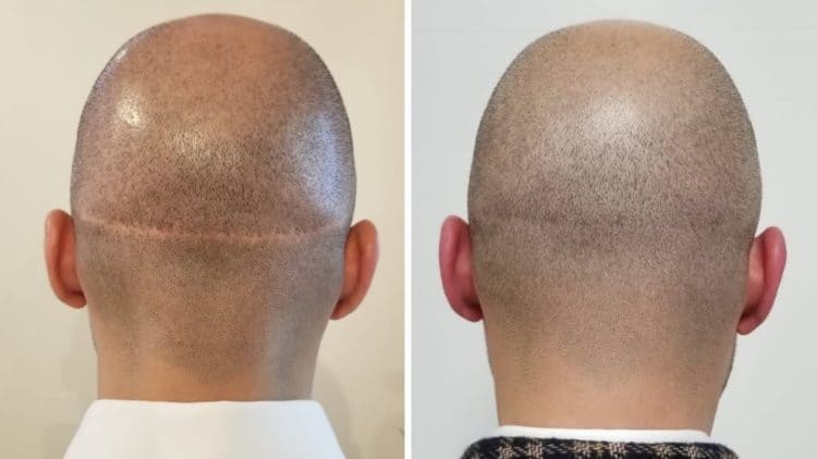 Getting rid of a transplant scar is possible with Scalp Micropigmentation.