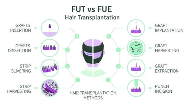 FUT vs FUE Hair Transplant Diagram