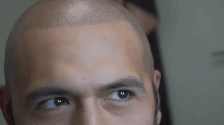 A hair tattoo as a hair restoration option.