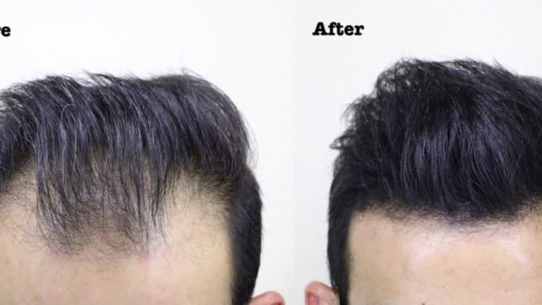 7 Ways to Fix a Bad Hairline (must-see) - Bald & Beards