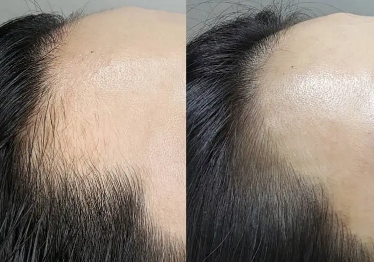 Good SMP can help a receding hairline look more natural.