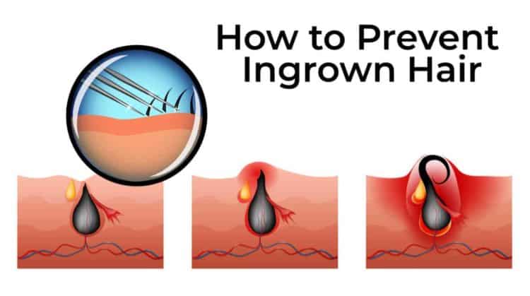 How to Prevent Ingrown Facial Hair