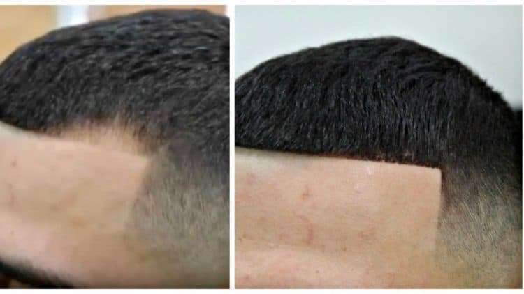 How hair thickening fibers fill in a bad hairline