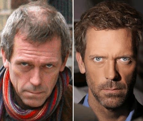 Hugh Laurie celebrity hair transplant (before and after).