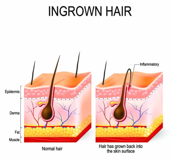 Normal vs Ingrown Hair Diagram.
