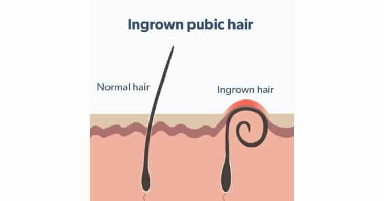 ingrown pubic hair