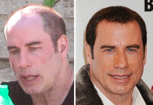 John Travolta celebrity hair transplant (before and after).