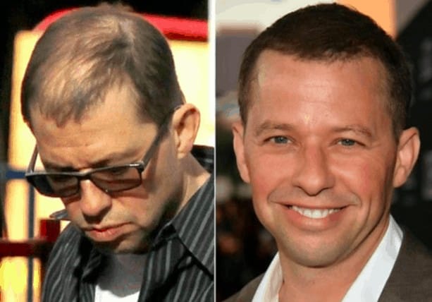 Jon Cryer celebrity hair transplant (before and after).