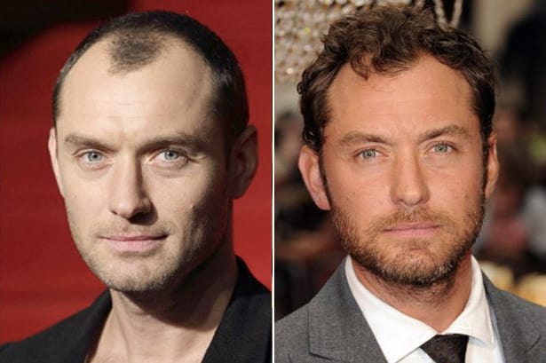 Jude Law celebrity hair transplant (before and after).