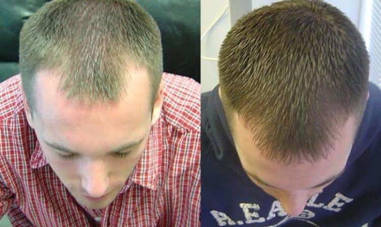Before After Laser Hair Growth Therapy