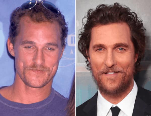 14 Celebrity Hair Transplants You Must See - Bald & Beards