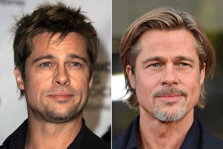 Brad Pitt juvenile vs mature hairline